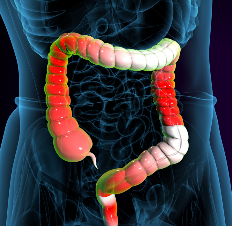 Read more about the article Morphic Therapeutics — Crohn’s Disease (Garnet)