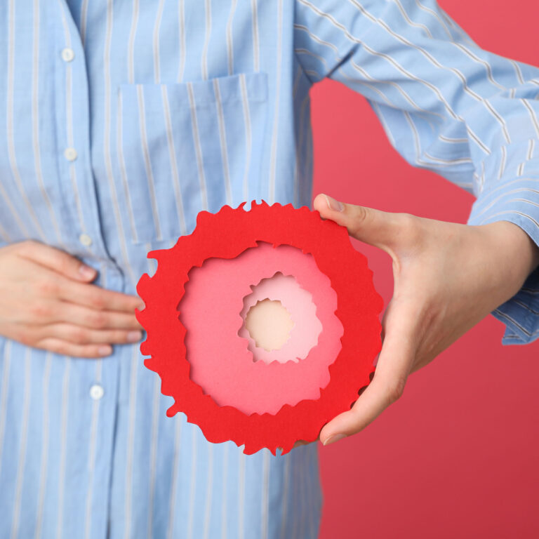 Read more about the article MRM StarFish Ulcerative Colitis